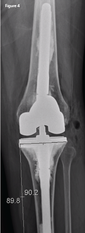 An anteroposterior X-ray of the left knee following revision arthroplasty. The lateral femoral and tibial overhang has been eliminated.