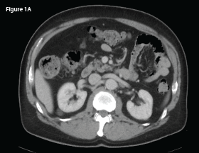 This CT of the abdomen from September 2017 demonstrates no intra-abdominal abnormalities or lymphadenopathy.
