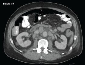 This CT of the abdomen from May 2018 demonstrates interval development of intra-abdominal lymphadenopathy (indicated by the white arrow).