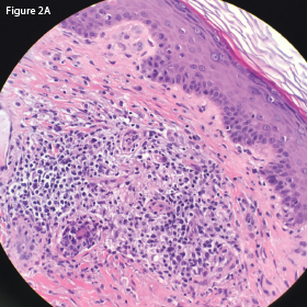 This hematoxylin and eosin (H&E) stain of the retroperitoneal lymph node at 40x magnification demonstrates atypical lymphocytes and numerous plasma cells.