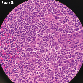 This H&E stain of the retroperitoneal lymph node at 60x magnification demonstrates enlarged and atypical lymphocytes.