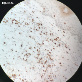 This CD3 stain at 40x magnification of the retroperitoneal lymph node demonstrates diffuse uptake.