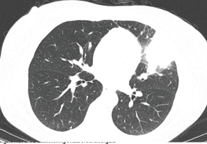 Figure 1: CT of the chest showing a mass in the left lingula.