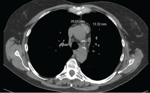 Figure 2: CT of the chest showing a mass in anterior mediastinum.