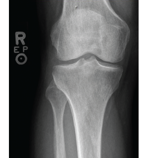 Figure 3: X-ray of the right knee showing periostosis of the fibula and tibia. 