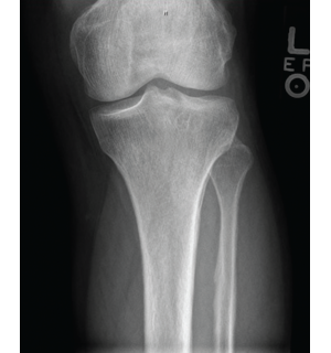 Figure 4: X-ray of the left knee showing periostosis of the fibula and tibia. 