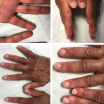The initial physical examination was significant for a nonblanching, papular rash along the palmar aspects of the hands and digits, periungual erythema, and edema and tenderness of the proximal and distal interphalangeal joints of the hands.