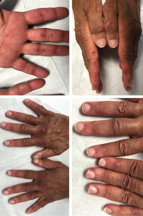 The initial physical examination was significant for a nonblanching, papular rash along the palmar aspects of the hands and digits, periungual erythema, and edema and tenderness of the proximal and distal interphalangeal joints of the hands.