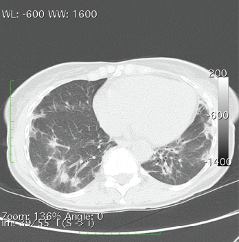 A CT of the chest without contrast showed multiple nodular and coalescing opacities involving the bilateral lungs diffusely, with more extensive involvement of the bibasilar regions.