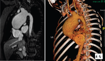 Large, aortic arch aneurysm as depicted by cMRI (left) and CTA (right). The aneurysm measured 4.4 x 4.9 cm at diagnosis and slowly grew over time, measuring 5.5 cm in diameter three years after diagnosis. 