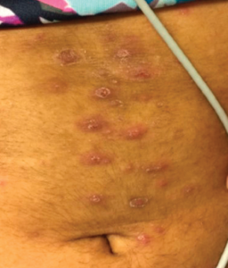 Hyperpigmented, maculopapular rash with overlying excoriation following rupture of prior pustules.