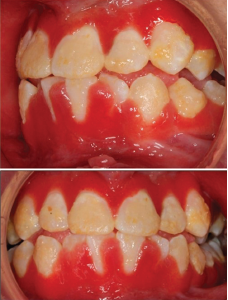 Hyperplastic, inflamed, erythematous and friable gingival lesions. 