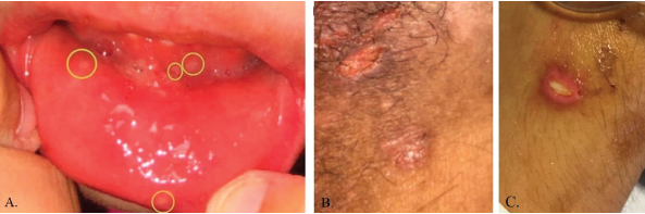 Pictures depicting oral ulcerations (A), genital ulceration (B) and cutaneous ulcer (C).