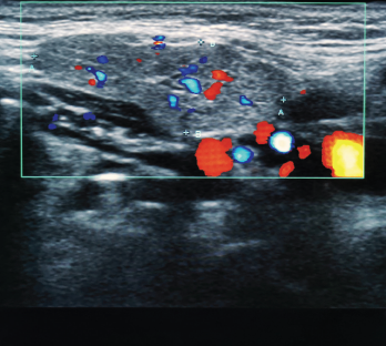 An ultrasound image of the submandibular salivary gland.
