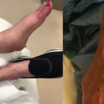 Case Report: Does She Have a Fungal Infection or Autoimmune Disease?