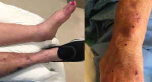 Case Report: Does She Have a Fungal Infection or Autoimmune Disease?