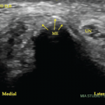 A transverse view of the ulnar groove in full elbow extension. The red arrow indicates the advancing edge of the MHTr.