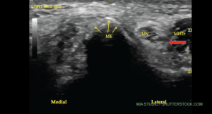 A transverse view of the ulnar groove in full elbow extension. The red arrow indicates the advancing edge of the MHTr.