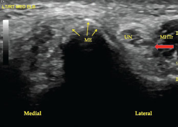 Figure 1. A transverse view of the ulnar groove in full elbow extension. The red arrow indicates the advancing edge of the MHTr.