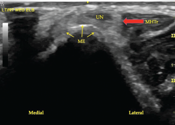 Figure 2. A transverse view of the ulnar groove in partial elbow flexion. Note the ulnar nerve and the medial head of the triceps muscle are both subluxing toward the apex of the medial epicondyle.
