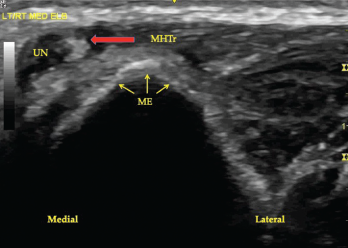Figure 3. A transverse view of the ulnar groove in full elbow flexion. Note the ulnar nerve and the medial head of the triceps muscle have both dislocated over the apex of the medial epicondyle. Key: UN, ulnar nerve; MHTr, medial head of the triceps muscle; ME, medial epicondyle.