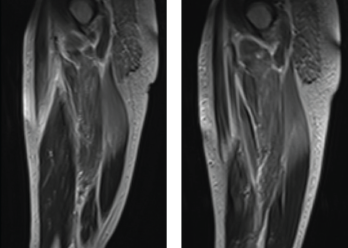 Figure 2: MRI. Magnetic resonance imaging of the bilateral thigh musculature shows extensive increased T2 signal throughout the gluteal musculature, as well as thigh musculature, most prominently in the posterior compartment.