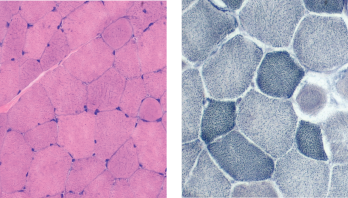 Hemotoxylin and eosin staining (left) and nicotinamide adenine dinucleotide staining (right) show mildly increased variation in single fiber sizes, with ring fibers.