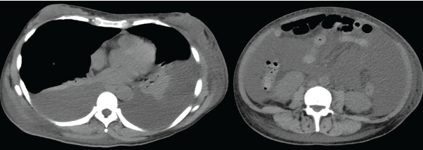 Figure 1: Computed tomography demonstrates bilateral pleural effusion and massive ascites.