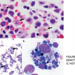 Figure 1A–C: Arrows denote hemophagocytic histiocytes.