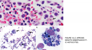 Figure 1A–C: Arrows denote hemophagocytic histiocytes.