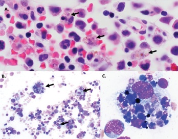 Figure 1A–C: Arrows denote hemophagocytic histiocytes.