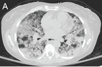 Figure 1: GPA radiographic progression