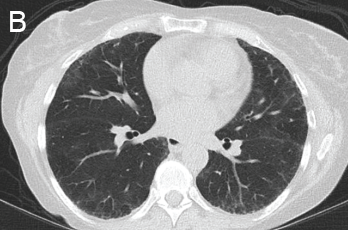 A) Diffuse, patchy, bilateral groundglass opacities and interlobular septal thickening with small patches of dense pulmonary consolidation are seen. B) Repeat CT after two doses of rituximab and steroids shows markedly improved groundglass opacities, resolved areas of consolidation and moderate residual subpleural interstitial lung disease.