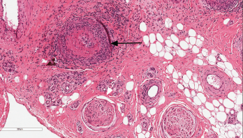 Figure 1: Nerve Biopsy