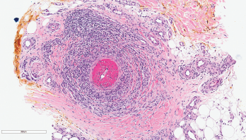 Figure 2: Skin Biopsy