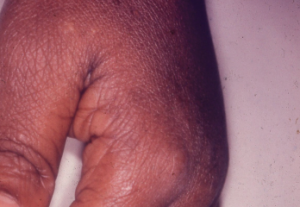This picture exemplifies the high visual quality required in the slide collection: clean background, focus on the specific problem, no distracting features like bandages, etc. In this case, the swan-neck deformity is very clearly illustrated and is the only abnormal point in this photograph. (One could argue that a small degree of MCP synovitis is present.)