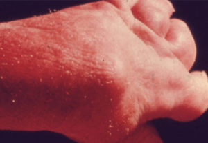 This is one of the very few slides in the first collection that allowed two images. In this case it demonstrates a fortunately now rare manifestation of very severe psoriatic arthritis mutilans, showing in identical poses what the hand looks like to a clinician and the very severe destructive disease seen radiologically. (In the original slide, the radiograph was much clearer. The slide was submitted by E. Carwile LeRoy.)