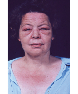 This photograph of a woman with dermatomyositis was included not only because it illustrates the rash and periorbital erythema, but also as an inside joke: John Decker, who closely advised the committee, rejected many slides because they showed periorbital edema, which he insisted was not necessary for a diagnosis of dermatomyositis. The committee challenged him to find a slide that did not show periorbital edema, and this is the best he could produce. Case closed.