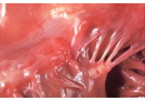 This beautifully composed photograph, without distracting features, shows Libman-Sacks endocarditis as seen at autopsy. In the days before echocardiography, clinicians knew of this lesion only by murmur, embolus or (rare) surgery for valve failure.