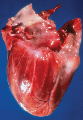 This gross specimen demonstrates a relatively normal coronary artery on the left and "beading" of the coronary artery on the right, secondary to segmental necrotizing arteritis.