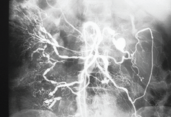 A selective angiogram of the superior mesenteric artery shows multiple saccular aneurysms that vary in size and shape. Note the irregularity of the vascular lumens with areas of stenosis and dilation.