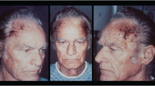 Bilateral scalp necrosis, an unusual finding in giant cell arteritis, is seen in this patient. Scalp necrosis is an uncommon manifestation of giant cell arteritis because of collateral arterial supply to the scalp.