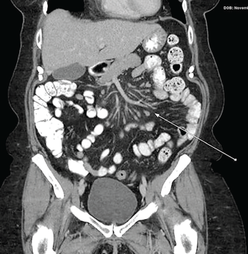 Figure 2: CT of the Abdomen & Pelvis with Contrast