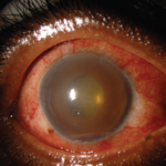 This external photograph of the right eye shows keratic precipitates on the corneal endothelium, corneal edema and hemorrhagic hypopyon in the setting of acute herpetic anterior uveitis.