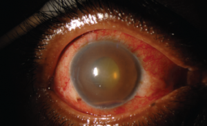 This external photograph of the right eye shows keratic precipitates on the corneal endothelium, corneal edema and hemorrhagic hypopyon in the setting of acute herpetic anterior uveitis.