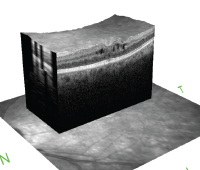 Cystoid macular edema is seen on optical coherence tomography. The hyporeflective spaces within the retina represent fluid accumulation due to inflammatory vascular leakage. This is most common cause of vision loss in patients with uveitis. 