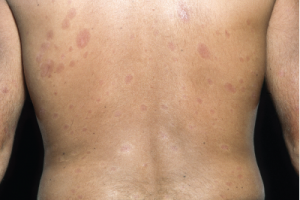 Plaques of thickened skin on the back of a patient with diffuse systemic sclerosis.