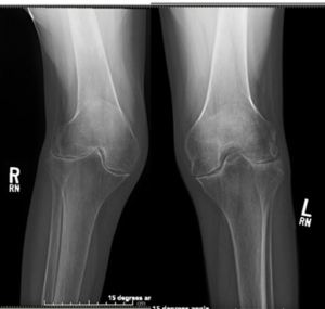 Bilateral symmetric joint space loss, erosions and periarticular osteopenia of the knee joints consistent with rheumatoid arthritis.