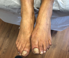 A visual examination in the physician’s office demonstrates a leg length discrepancy in a patient with unilateral osteoarthritis.