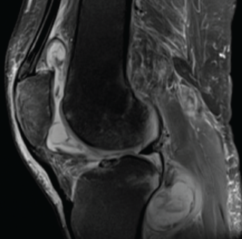 Magnetic resonance imaging of the patient’s left knee shows joint effusion, synovial thickening, and periarticular muscle and soft tissue edema.